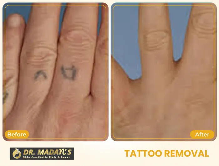Tattoo removal before and after result 12 at Dr Madan Aesthetics